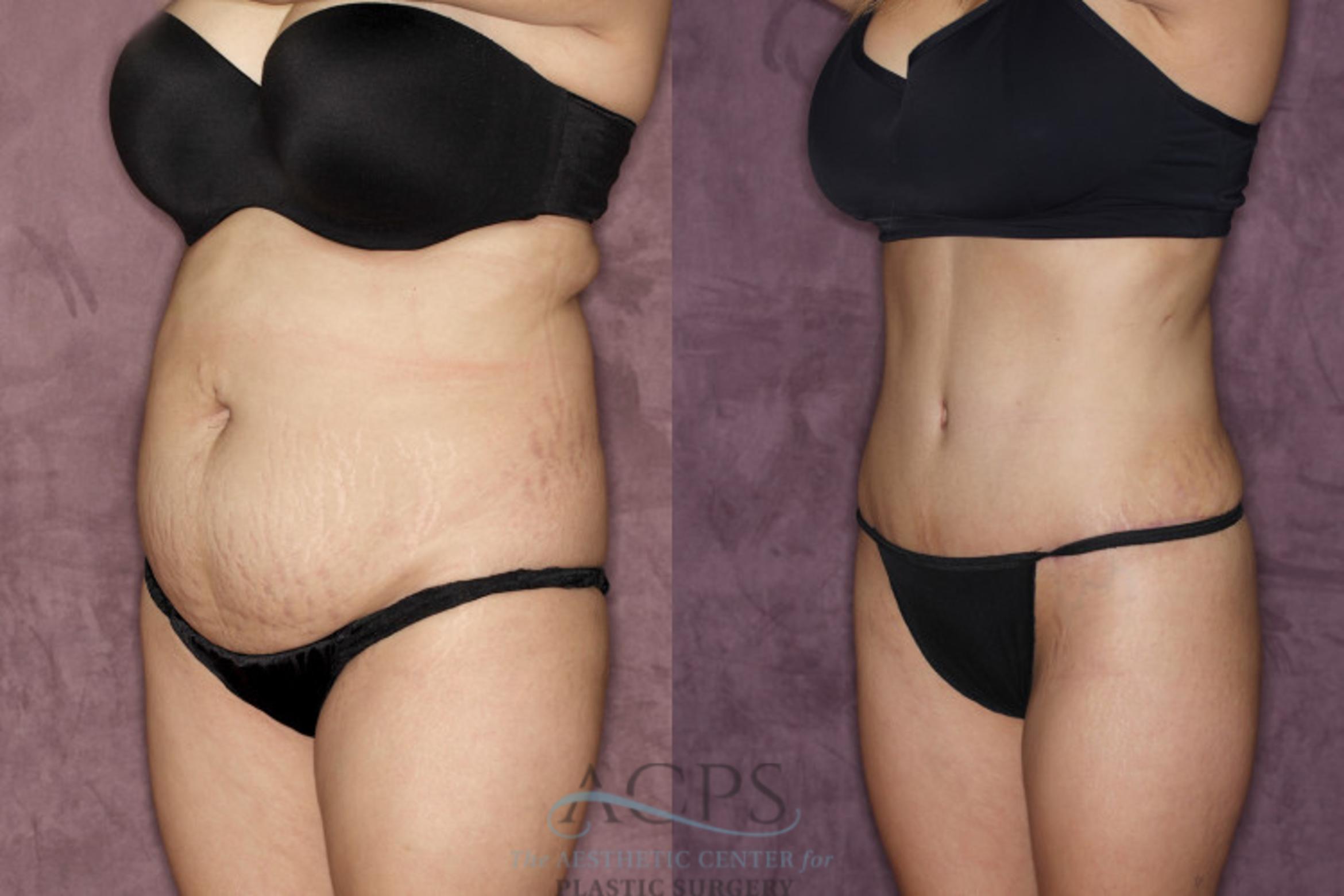 Before & After Tummy Tuck Case 38 Oblique Left View: View in Houston, TX