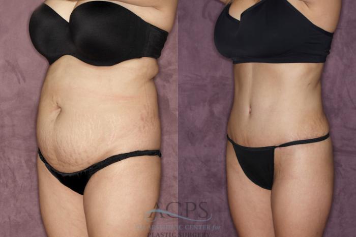 Before & After Tummy Tuck Case 38 Oblique Left View: View in Houston, TX