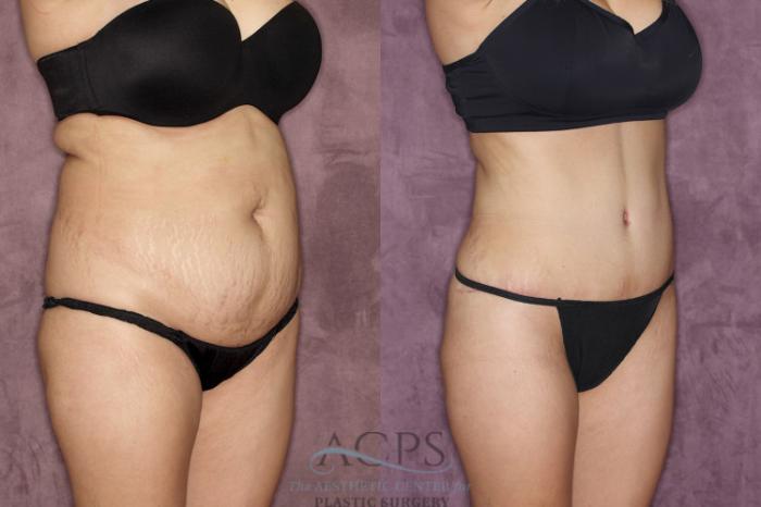 Before & After Tummy Tuck Case 38 Oblique Right View: View in Houston, TX