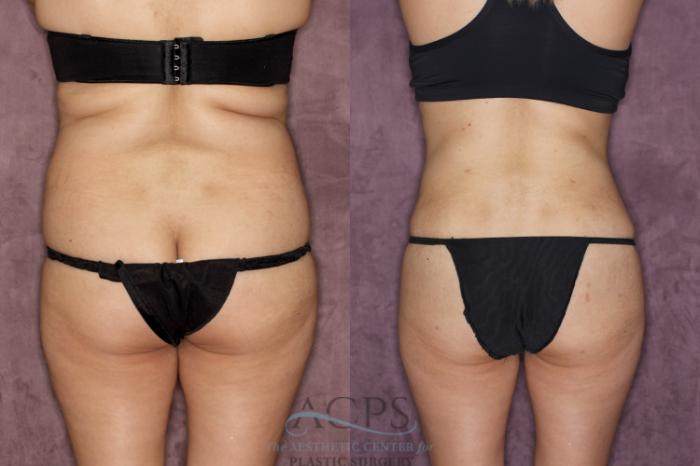Before & After Tummy Tuck Case 38 Rear View: View in Houston, TX