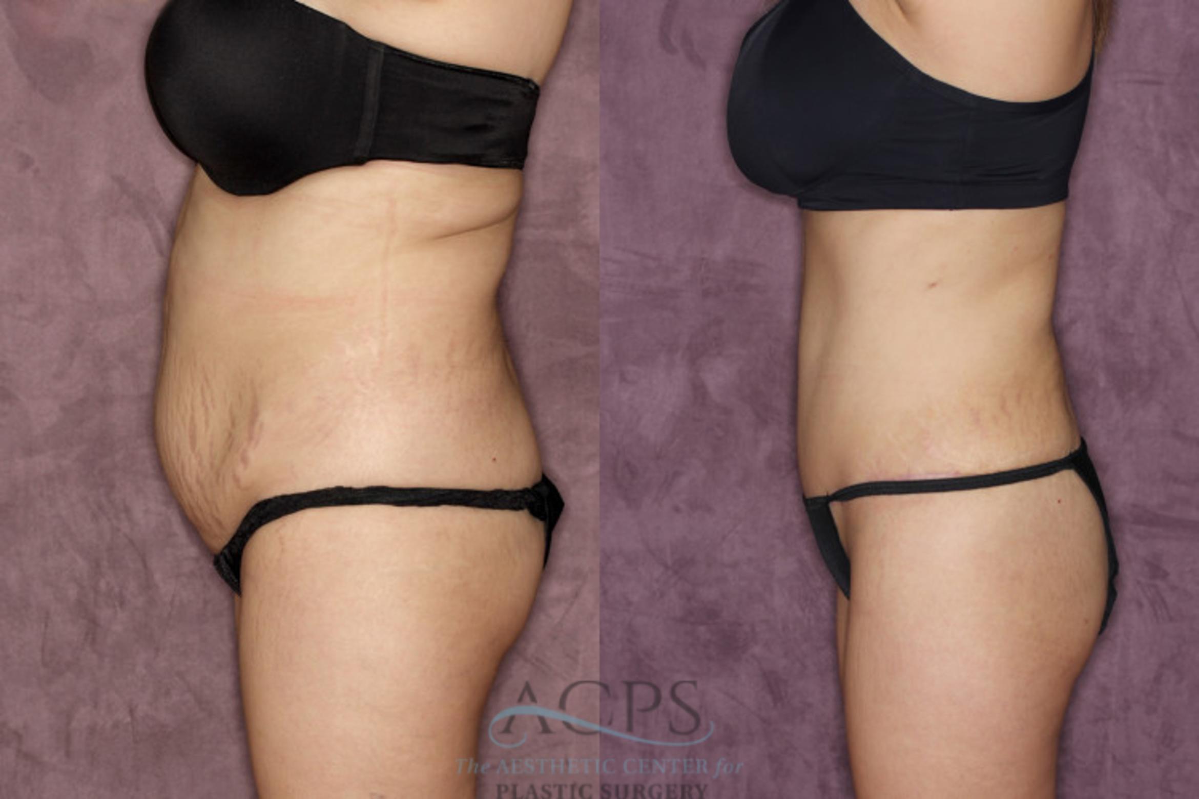 Before & After Tummy Tuck Case 38 Side Left View: View in Houston, TX