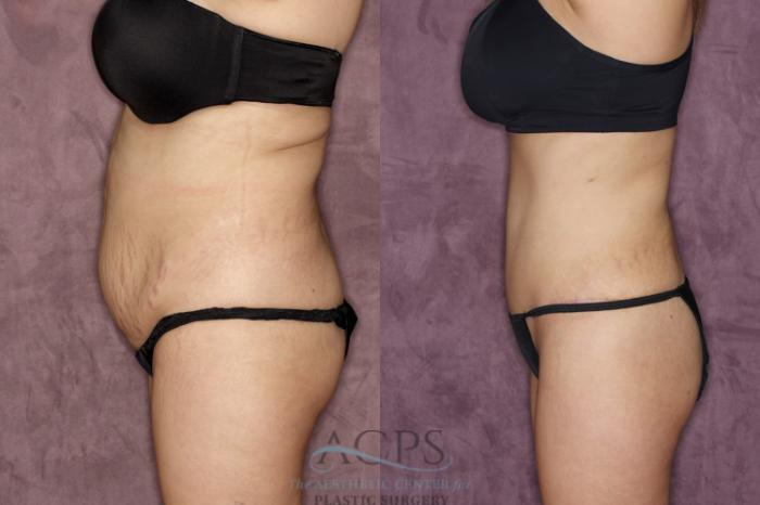 Before & After Tummy Tuck Case 38 Side Left View: View in Houston, TX