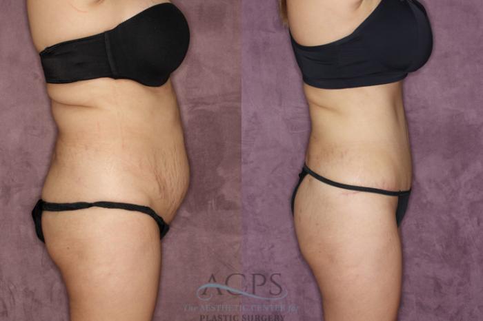 Before & After Tummy Tuck Case 38 Side Right View: View in Houston, TX
