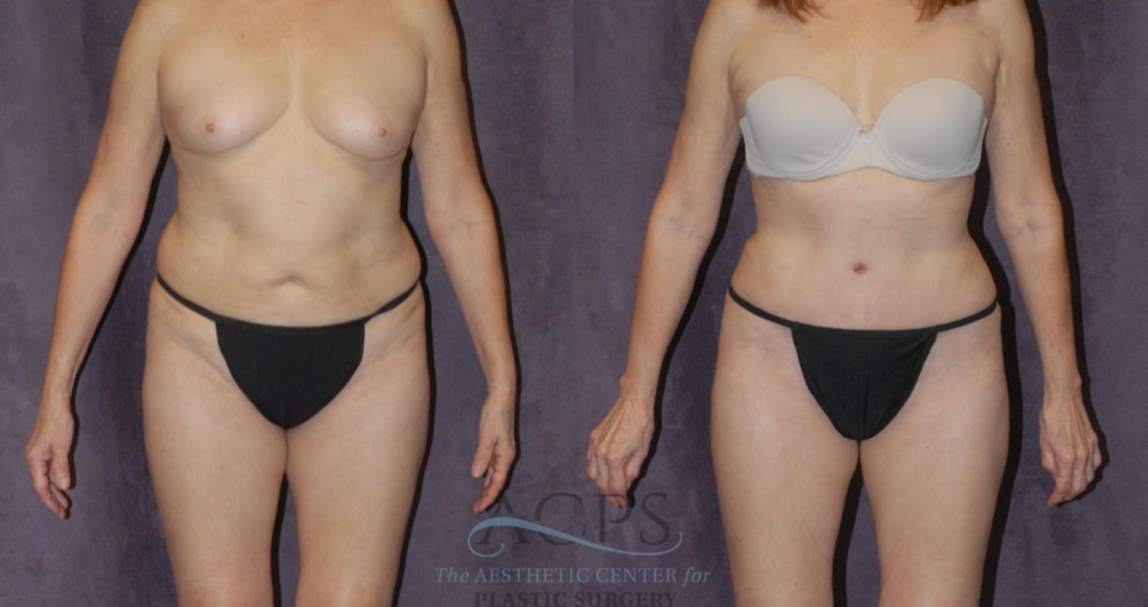 Before & After Tummy Tuck Case 39 Front View: View in Houston, TX