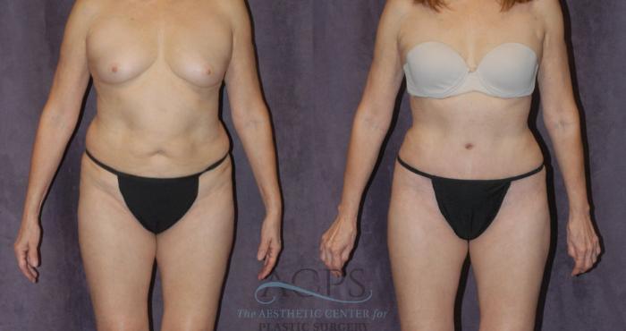Before & After Tummy Tuck Case 39 Front View: View in Houston, TX