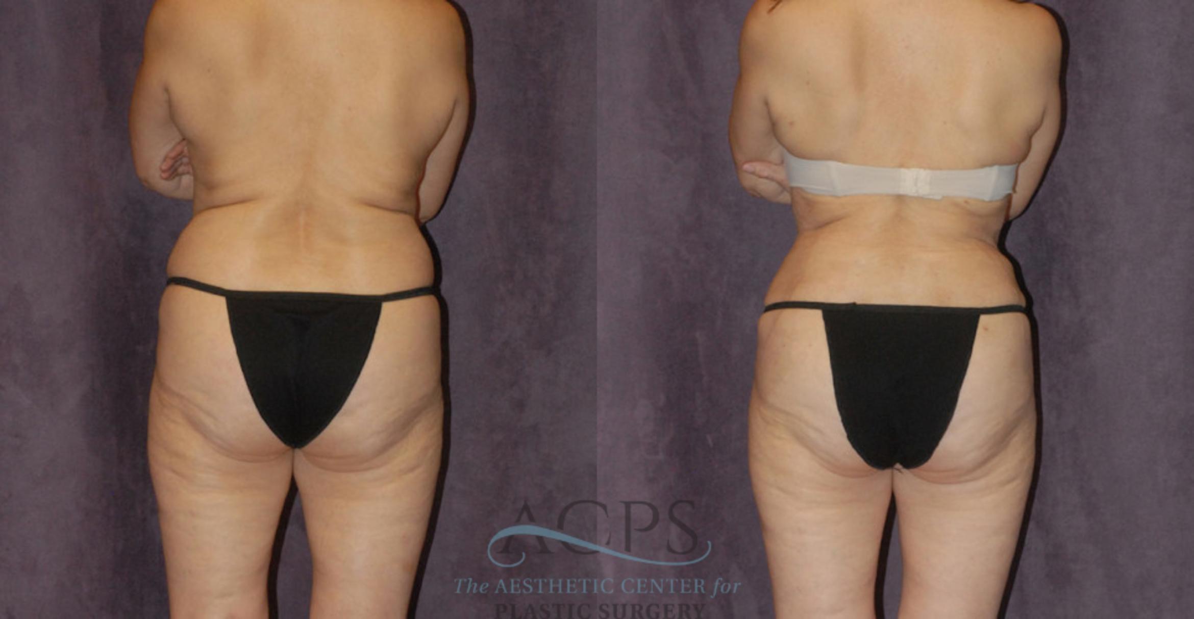 Before & After Tummy Tuck Case 39 Rear View: View in Houston, TX