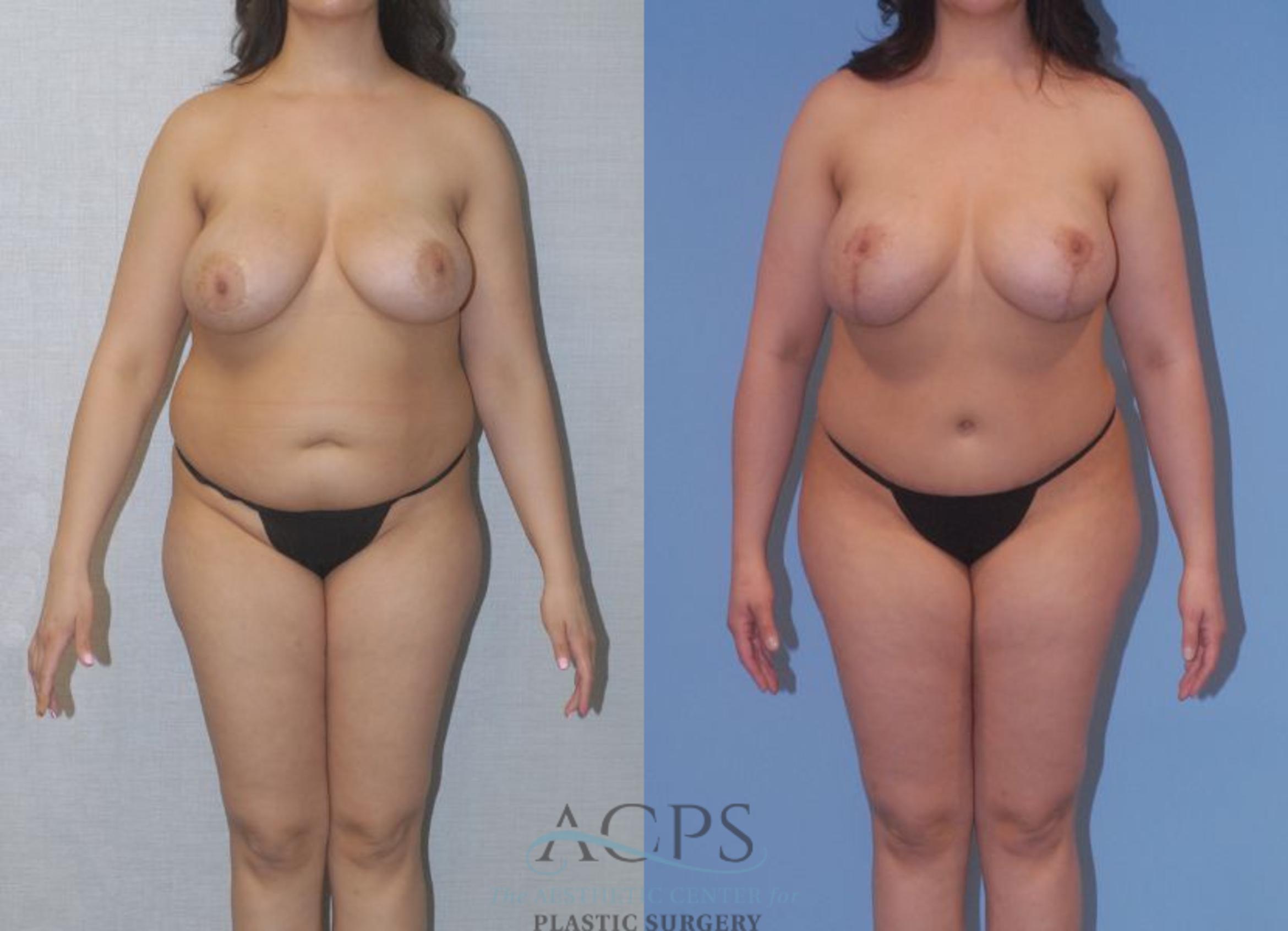 Before & After Tummy Tuck Case 4 Front View: View in Houston, TX