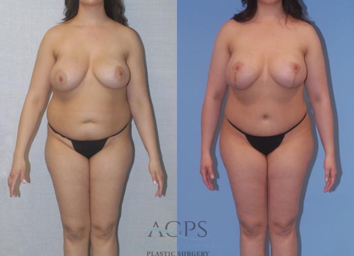 Before & After Tummy Tuck Case 4 Front View: View in Houston, TX