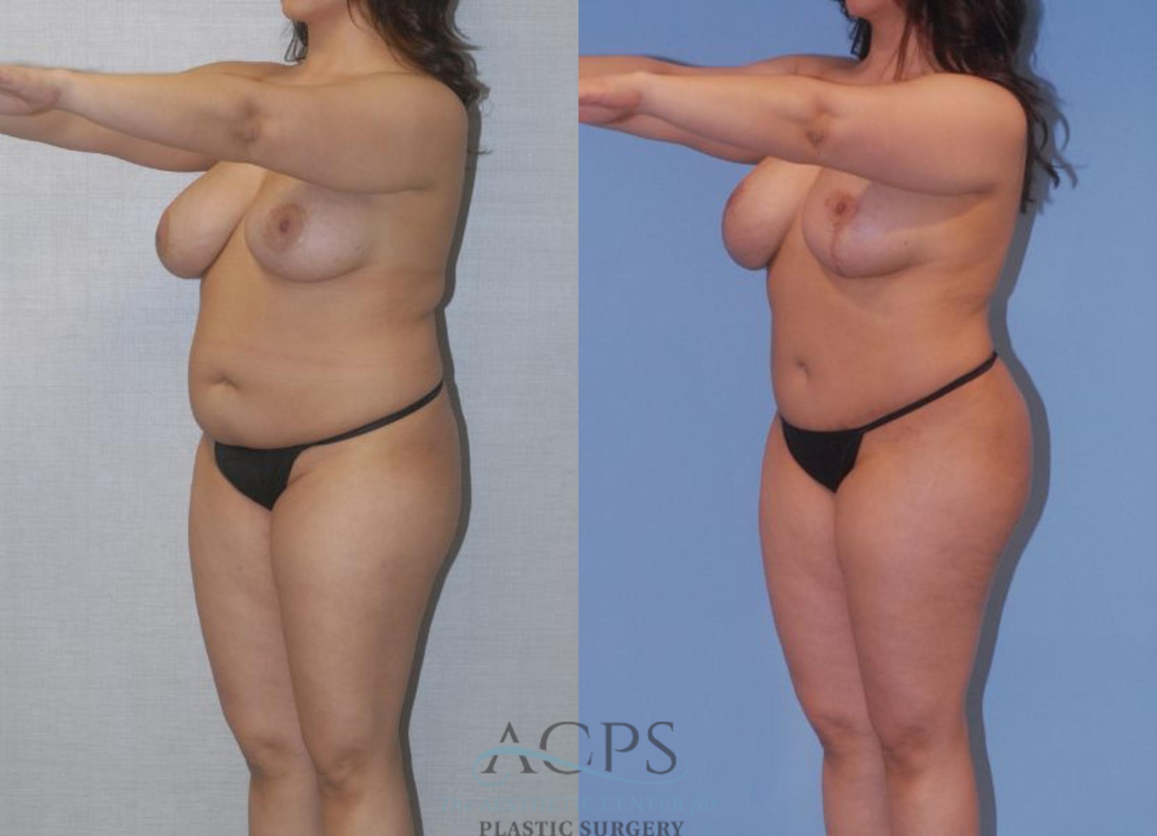 Before & After Tummy Tuck Case 4 Left Oblique View: View in Houston, TX