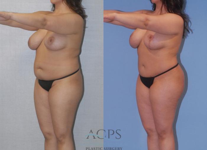 Before & After Tummy Tuck Case 4 Left Oblique View: View in Houston, TX