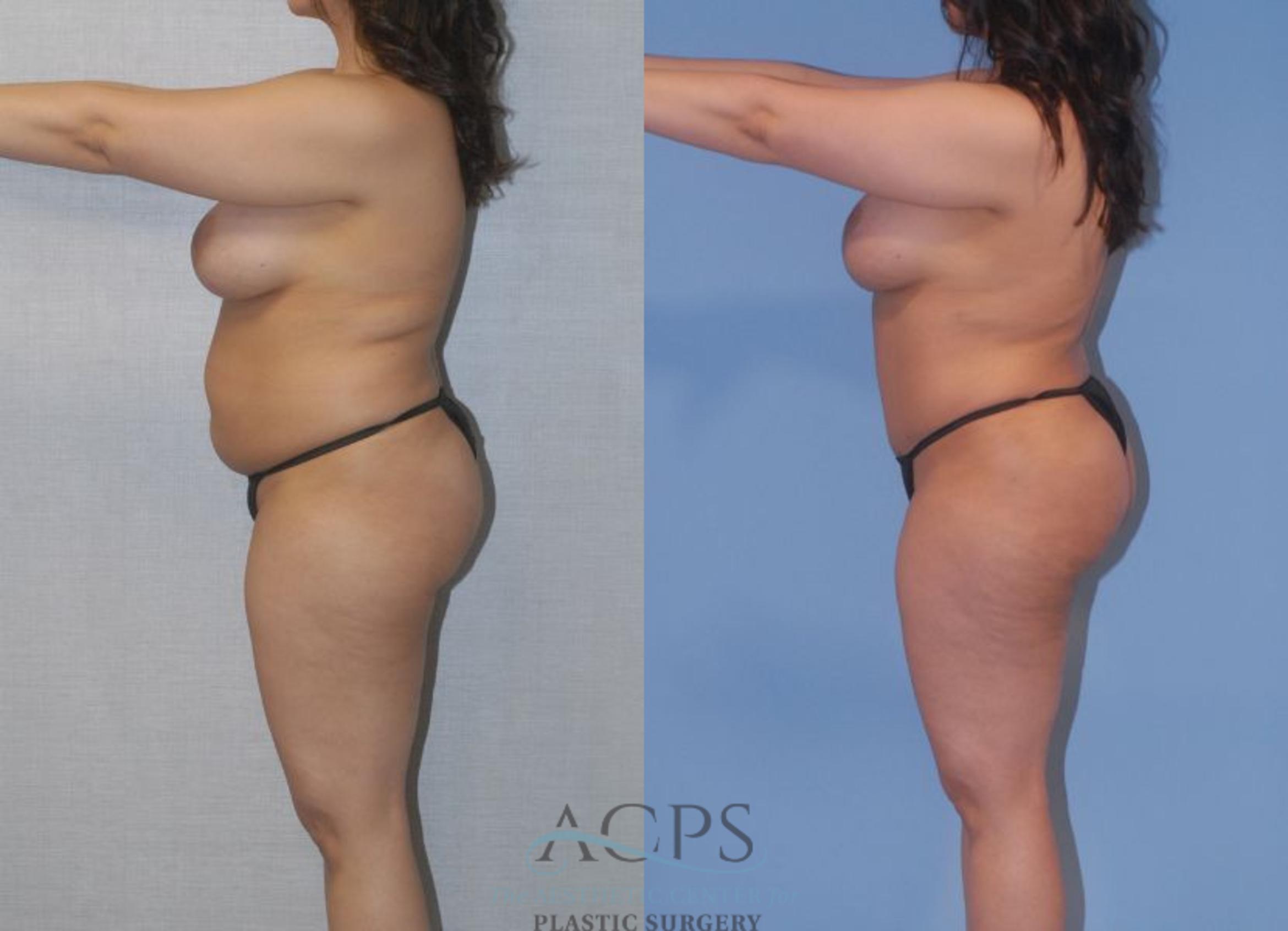Before & After Tummy Tuck Case 4 Left Side View: View in Houston, TX