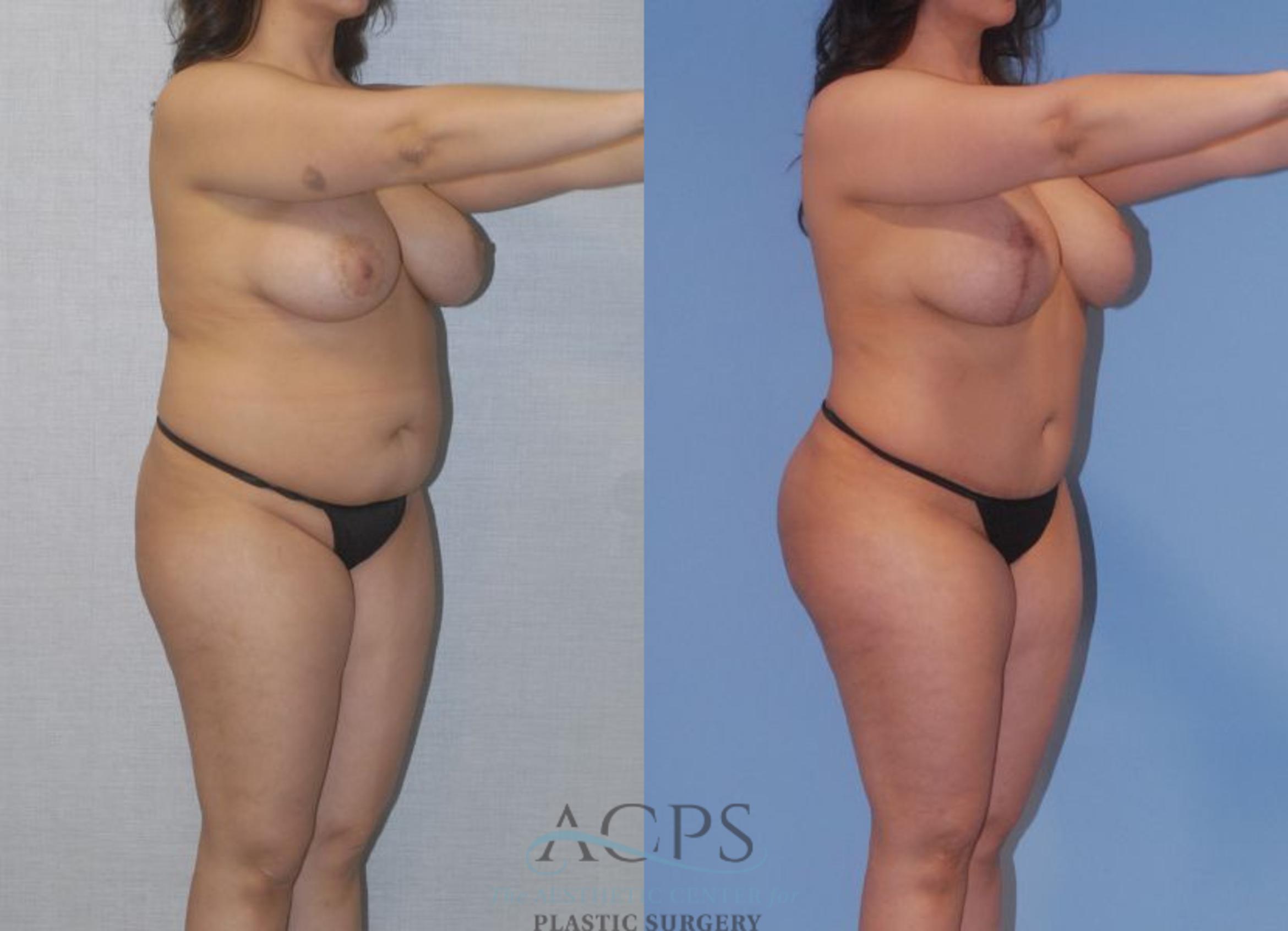 Before & After Tummy Tuck Case 4 Oblique View: View in Houston, TX