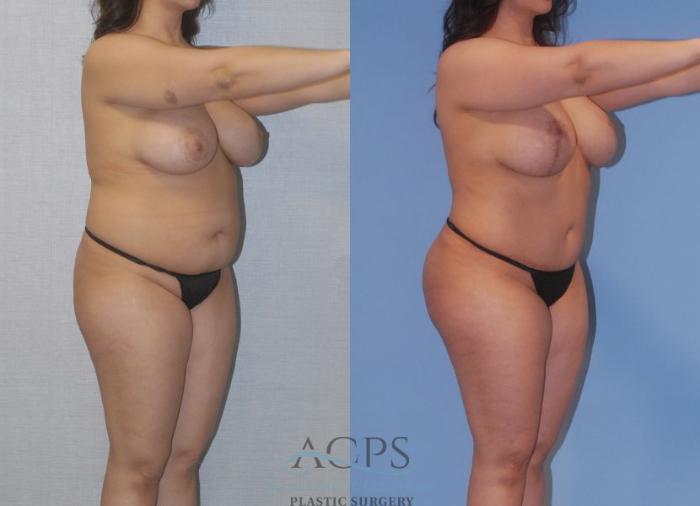 Before & After Tummy Tuck Case 4 Oblique View: View in Houston, TX