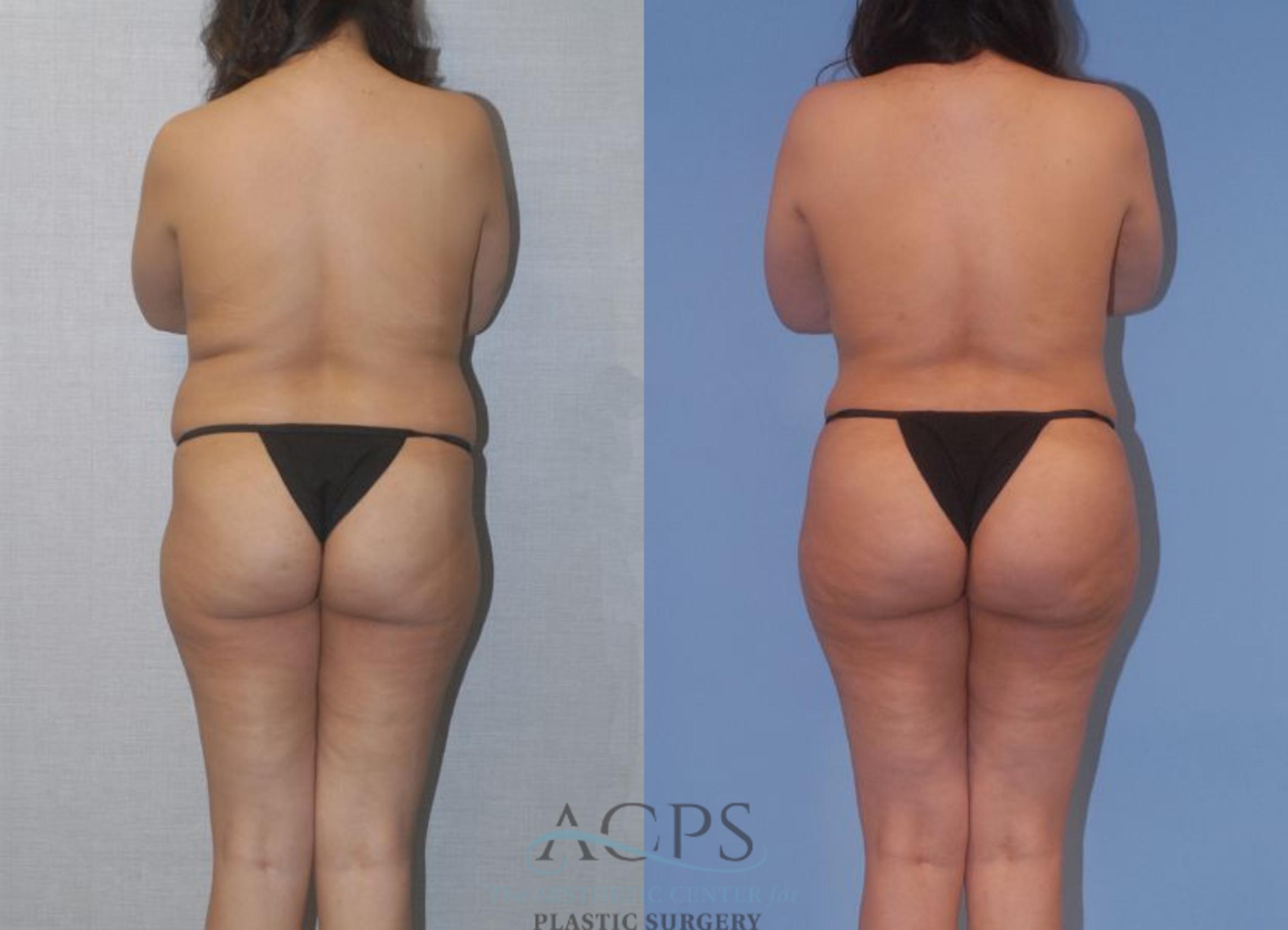 Before & After Tummy Tuck Case 4 Rear View: View in Houston, TX