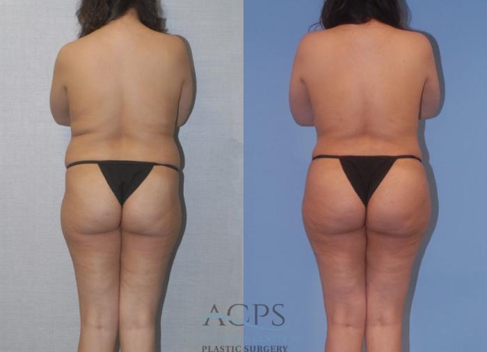 Before & After Tummy Tuck Case 4 Rear View: View in Houston, TX