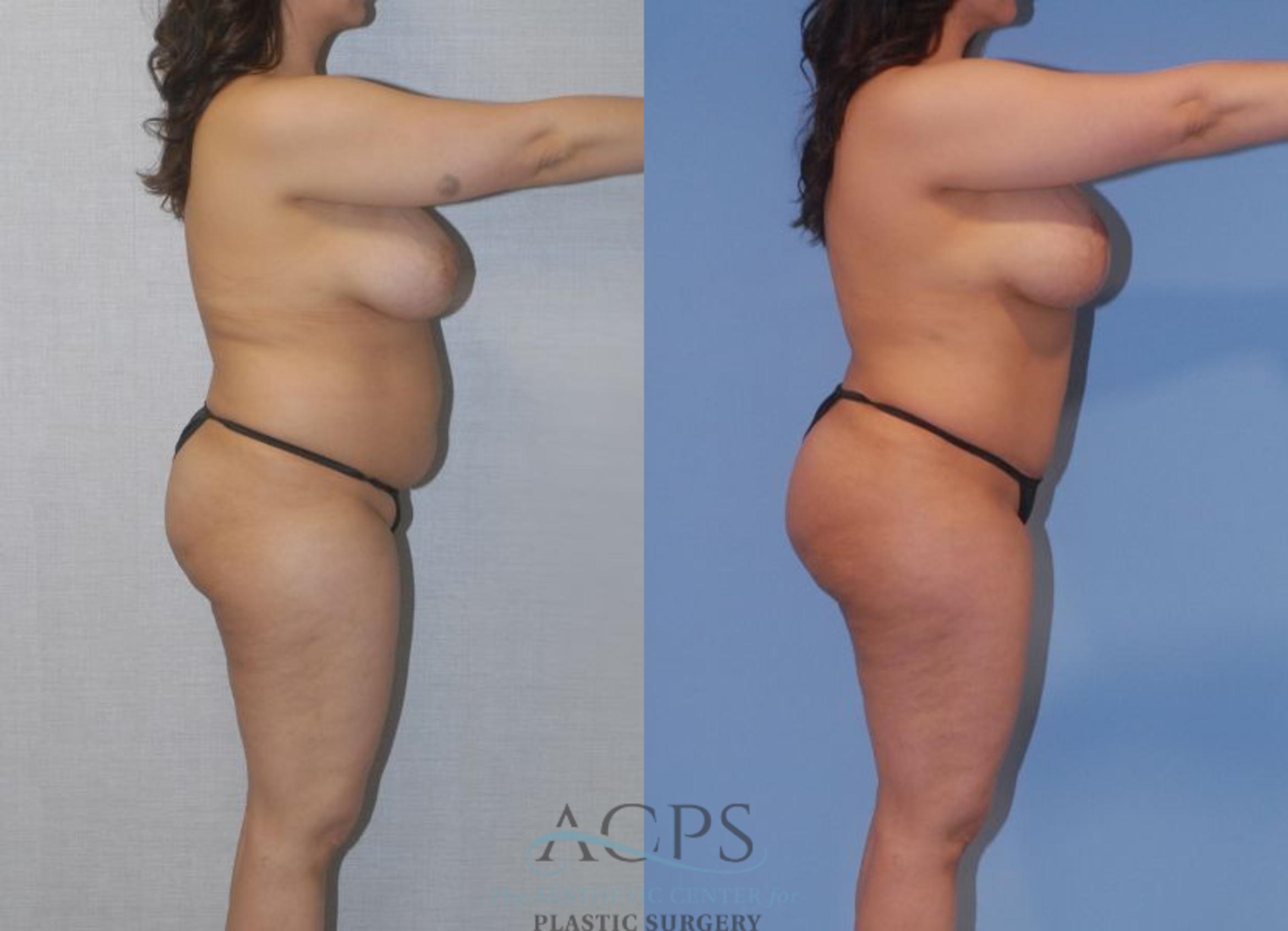 Before & After Tummy Tuck Case 4 Right Side View: View in Houston, TX