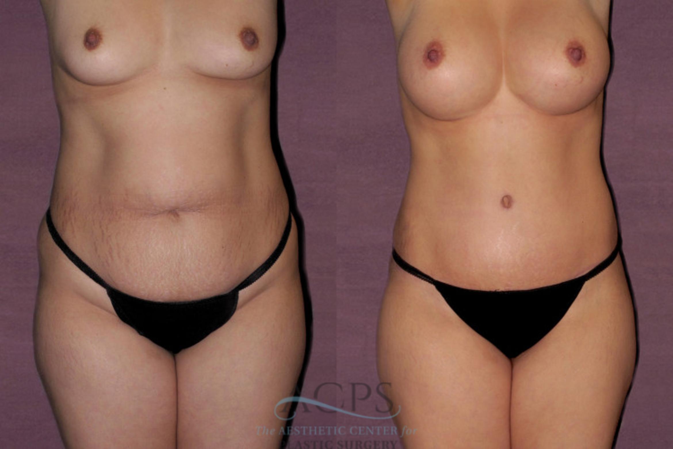 Before & After Tummy Tuck Case 40 Front View: View in Houston, TX