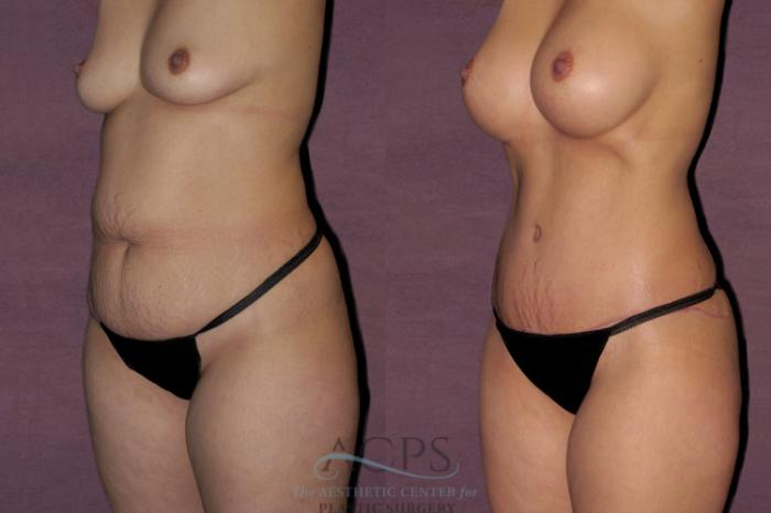 Before & After Tummy Tuck Case 40 Oblique Left View: View in Houston, TX