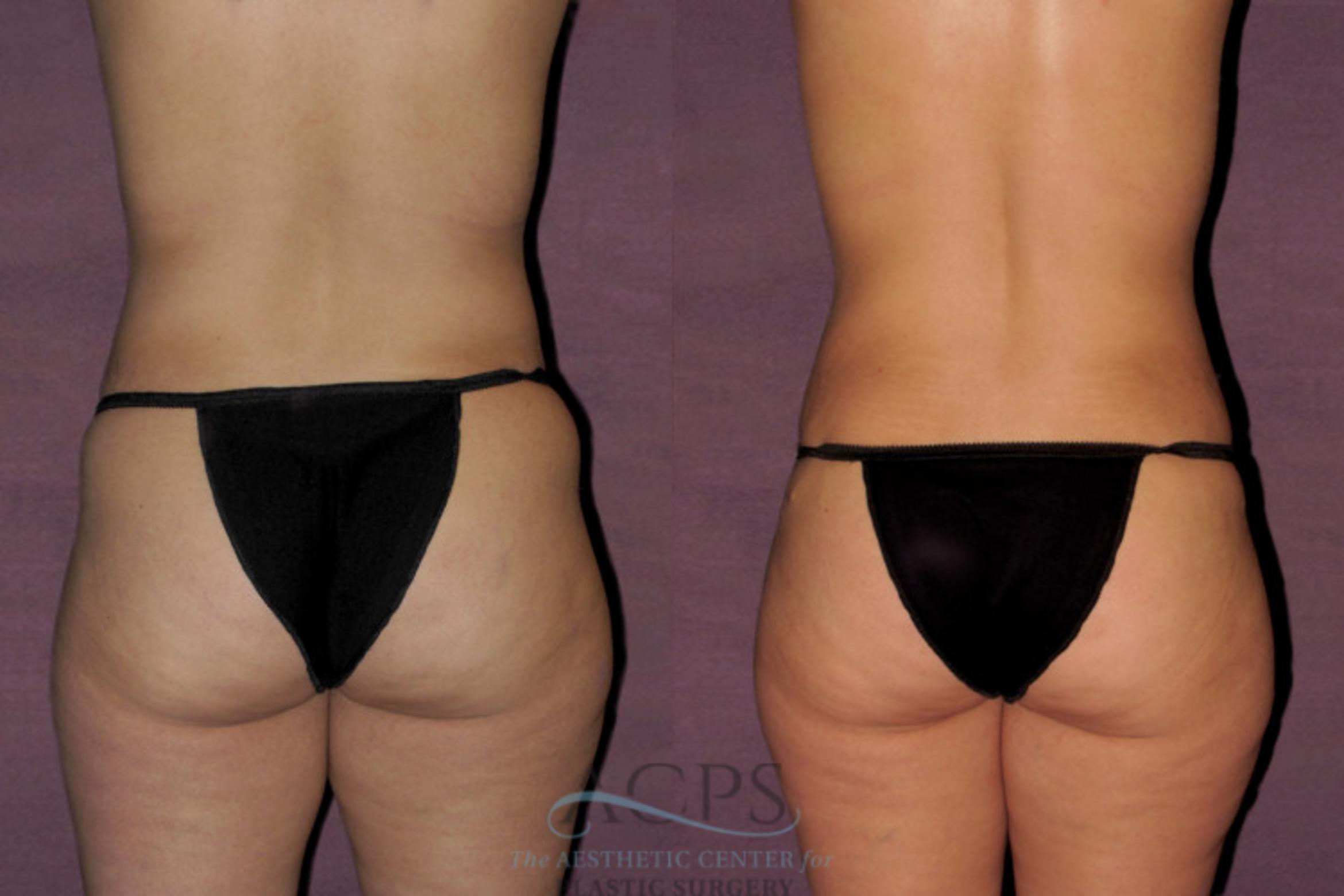 Before & After Tummy Tuck Case 40 Rear View: View in Houston, TX