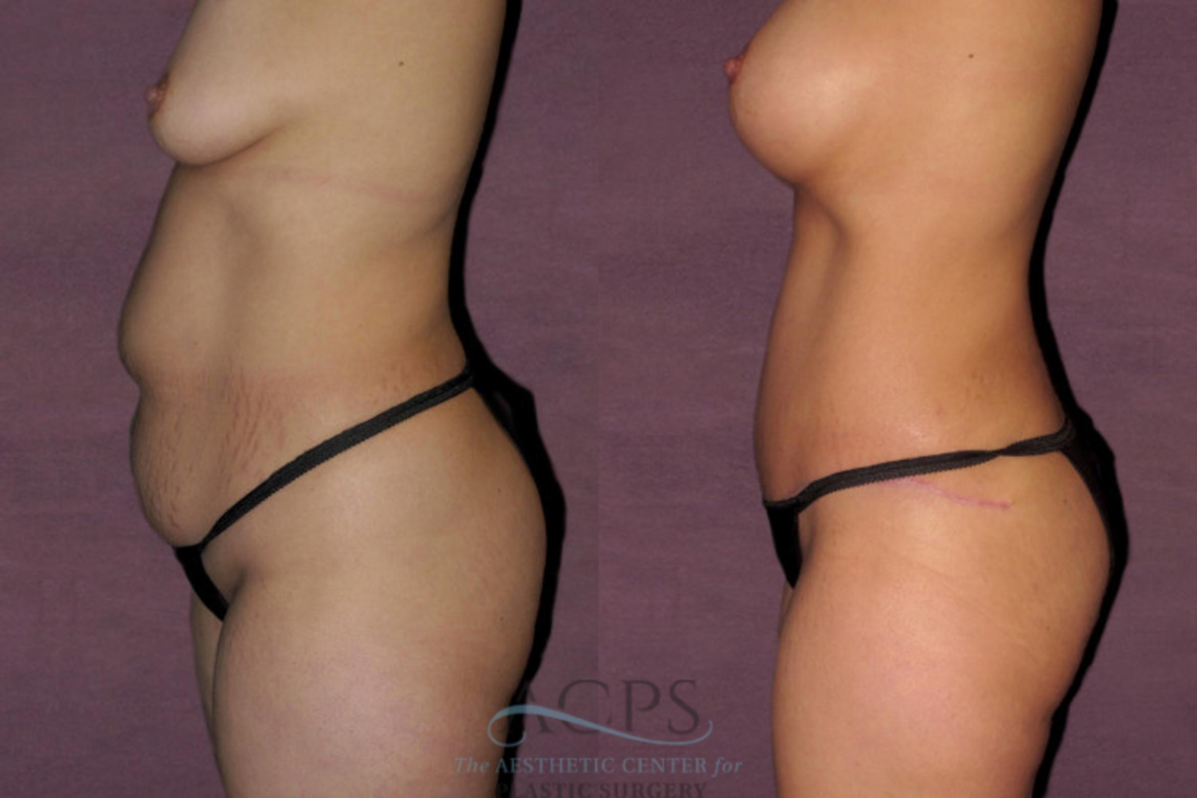 Before & After Tummy Tuck Case 40 Side Left View: View in Houston, TX