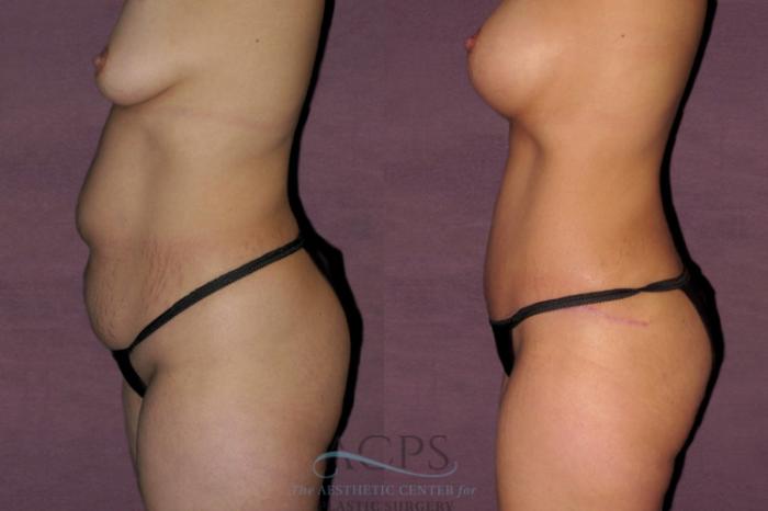 Before & After Tummy Tuck Case 40 Side Left View: View in Houston, TX