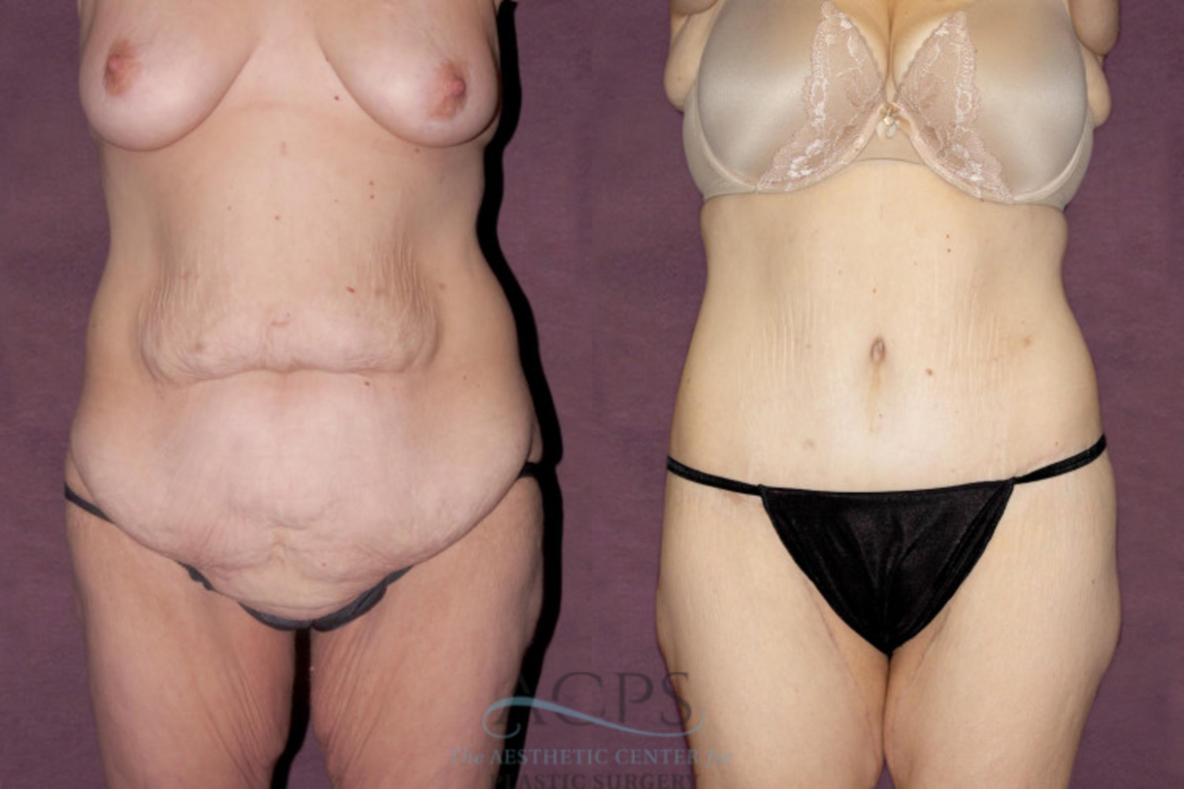 Before & After Tummy Tuck Case 41 Front View: View in Houston, TX