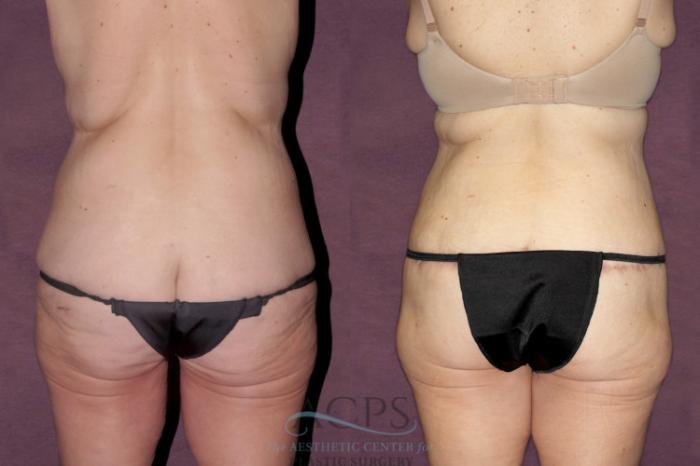 Before & After Tummy Tuck Case 41 Rear View: View in Houston, TX