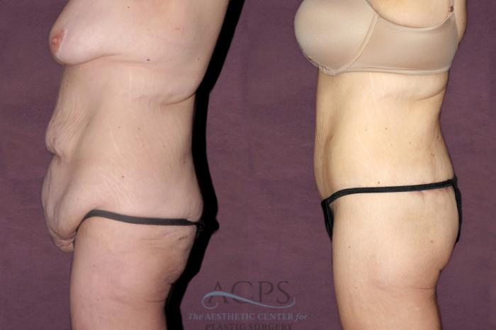 Before & After Tummy Tuck Case 41 Side Left View: View in Houston, TX