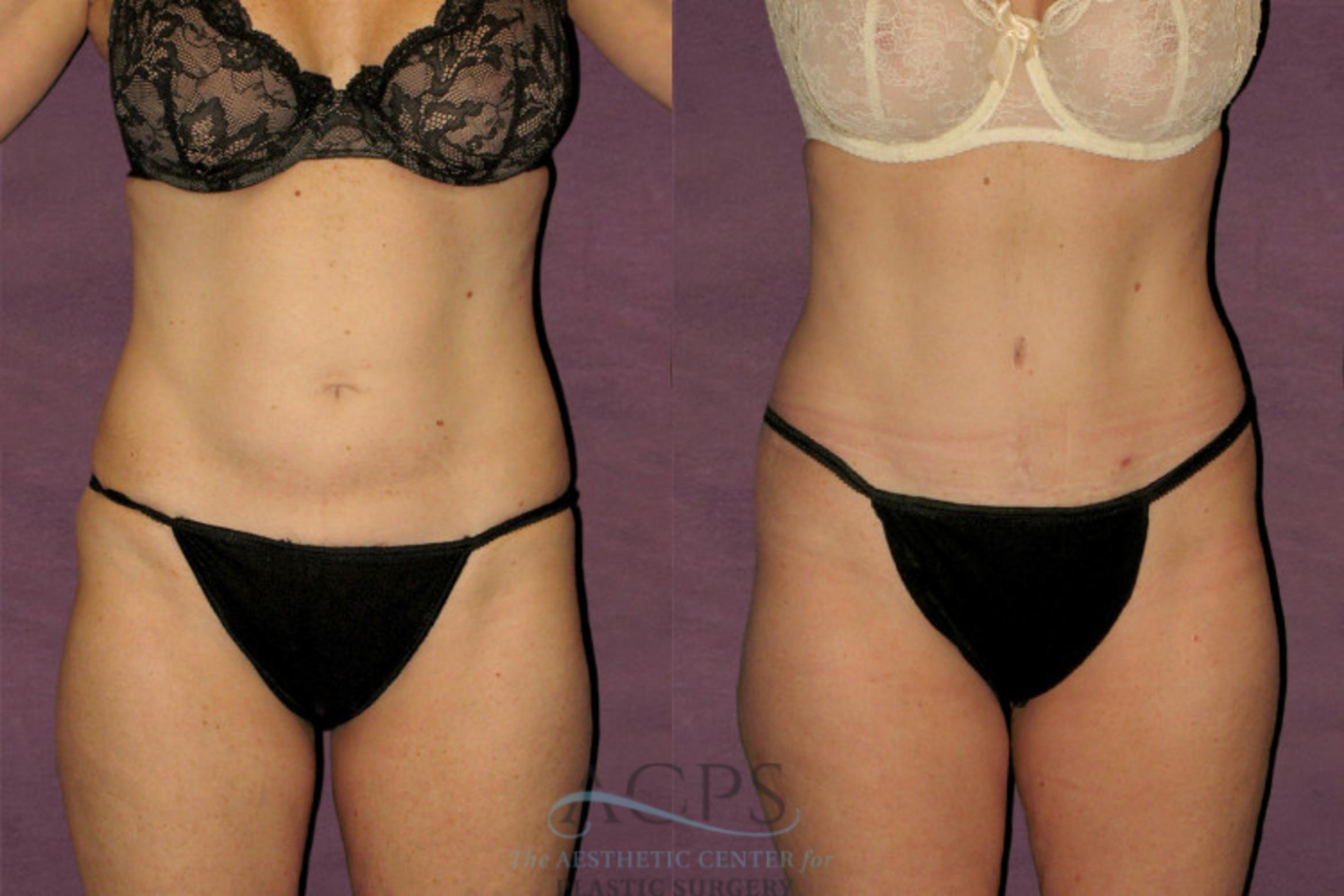 Before & After Tummy Tuck Case 42 Front View: View in Houston, TX