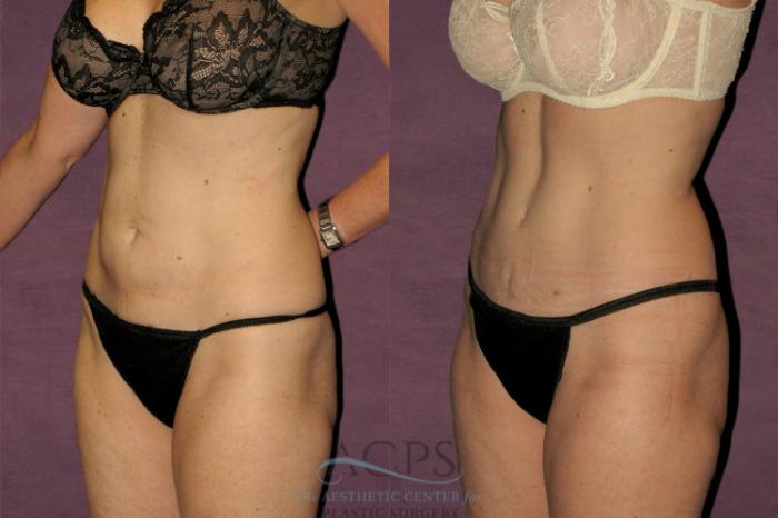 Before & After Tummy Tuck Case 42 Oblique Left View: View in Houston, TX