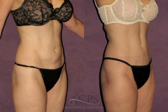 Before & After Tummy Tuck Case 42 Oblique Right View: View in Houston, TX
