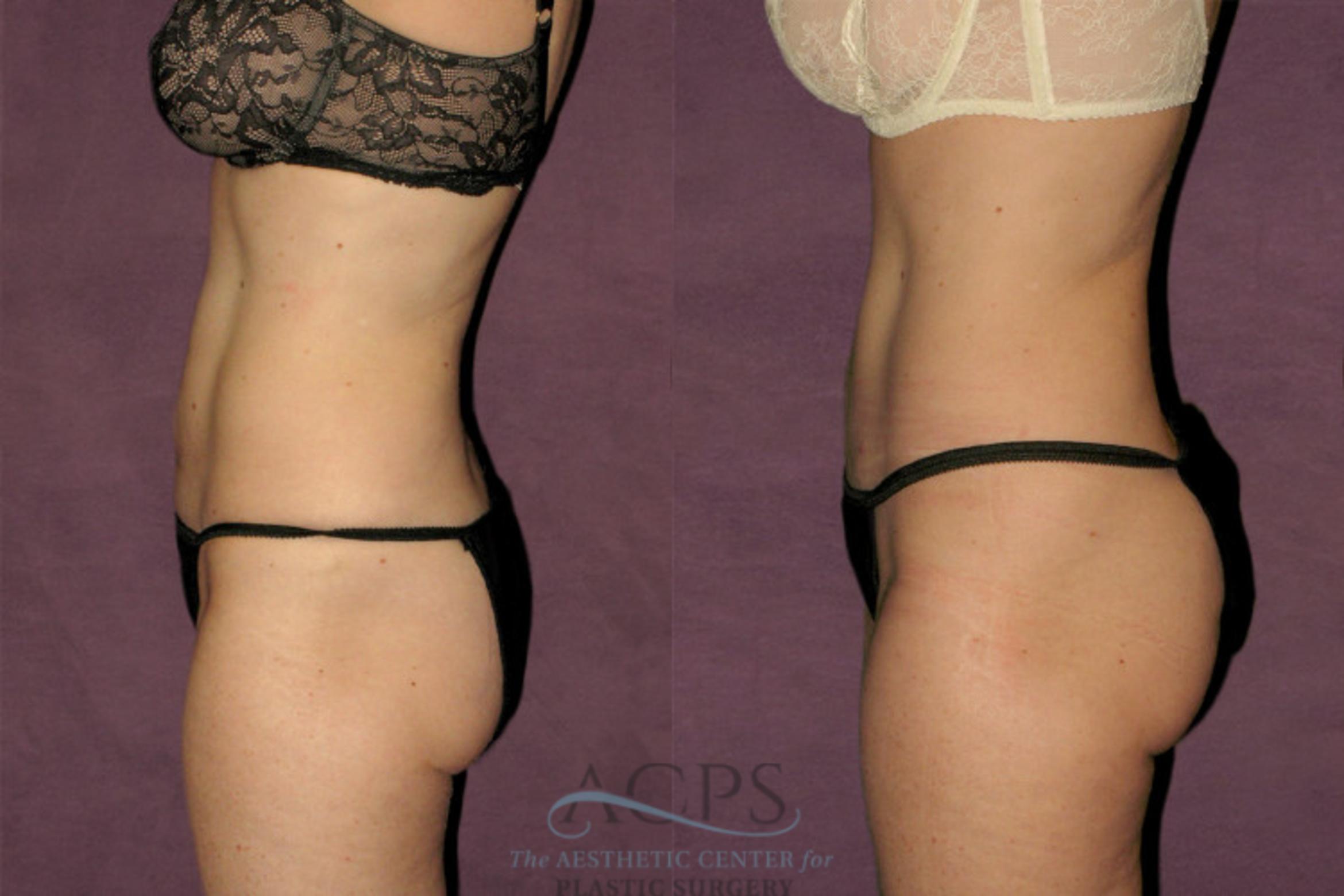 Before & After Tummy Tuck Case 42 Side Left View: View in Houston, TX