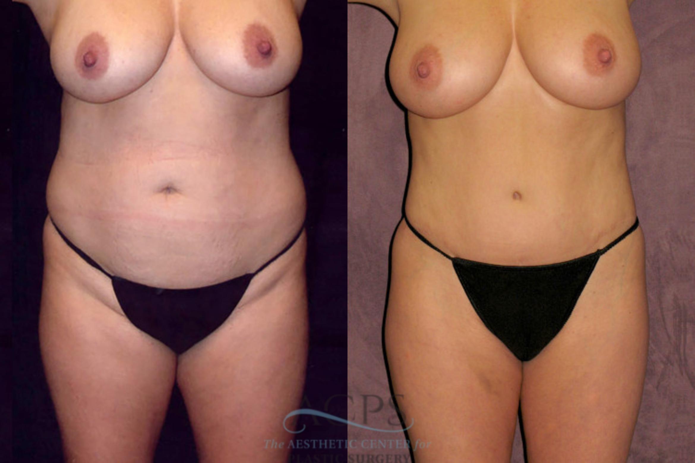 Before & After Liposuction Case 43 Front View: View in Houston, TX