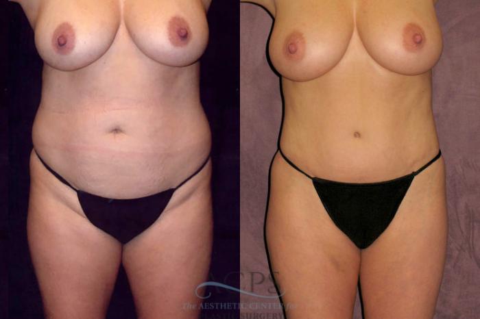 Before & After Liposuction Case 43 Front View: View in Houston, TX