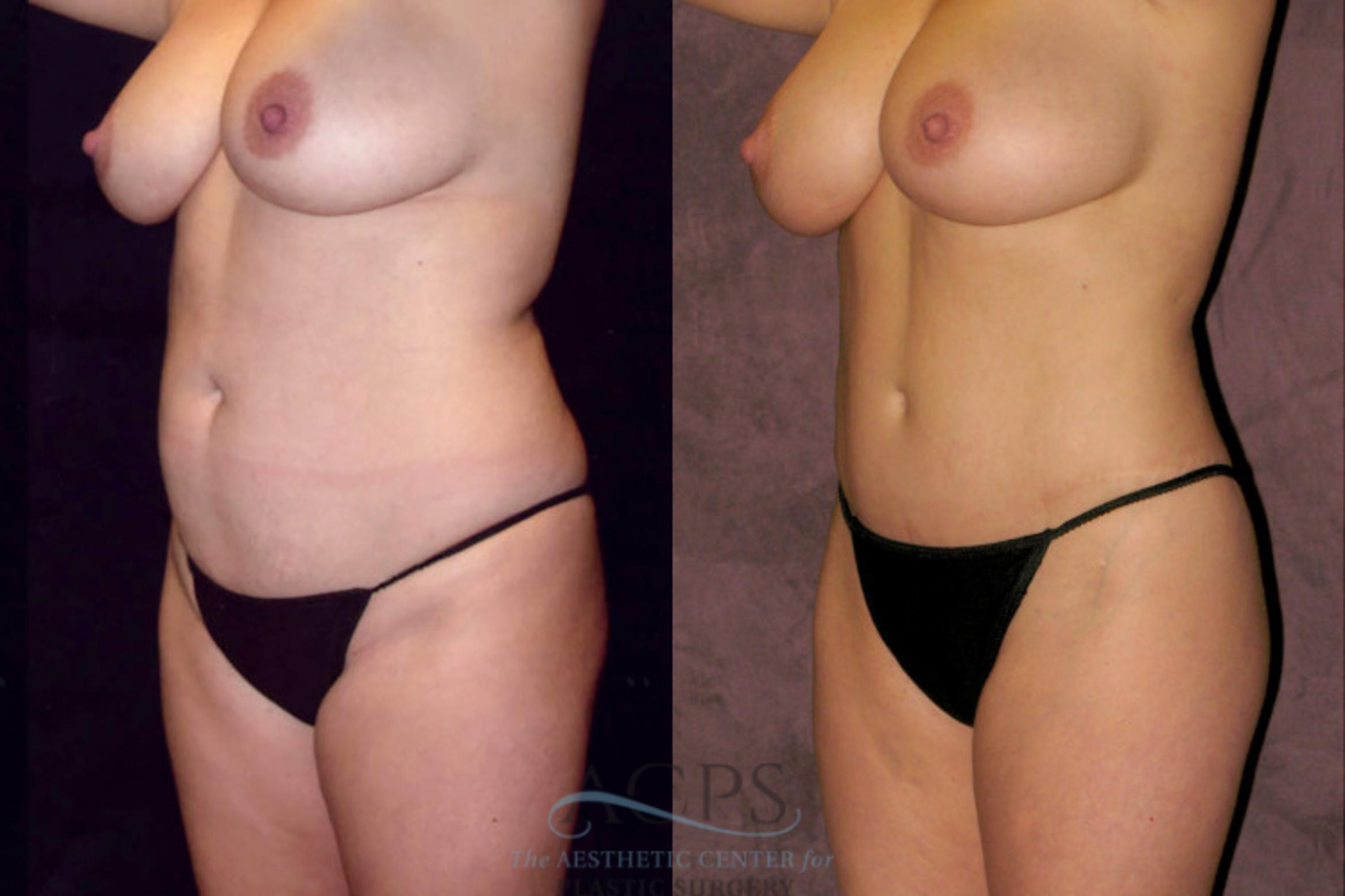 Before & After Liposuction Case 43 Oblique Left View: View in Houston, TX