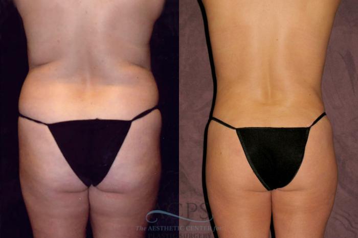 Before & After Liposuction Case 43 Rear View: View in Houston, TX