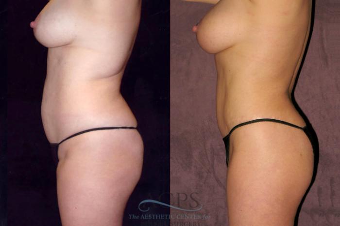Before & After Liposuction Case 43 Side Left View: View in Houston, TX