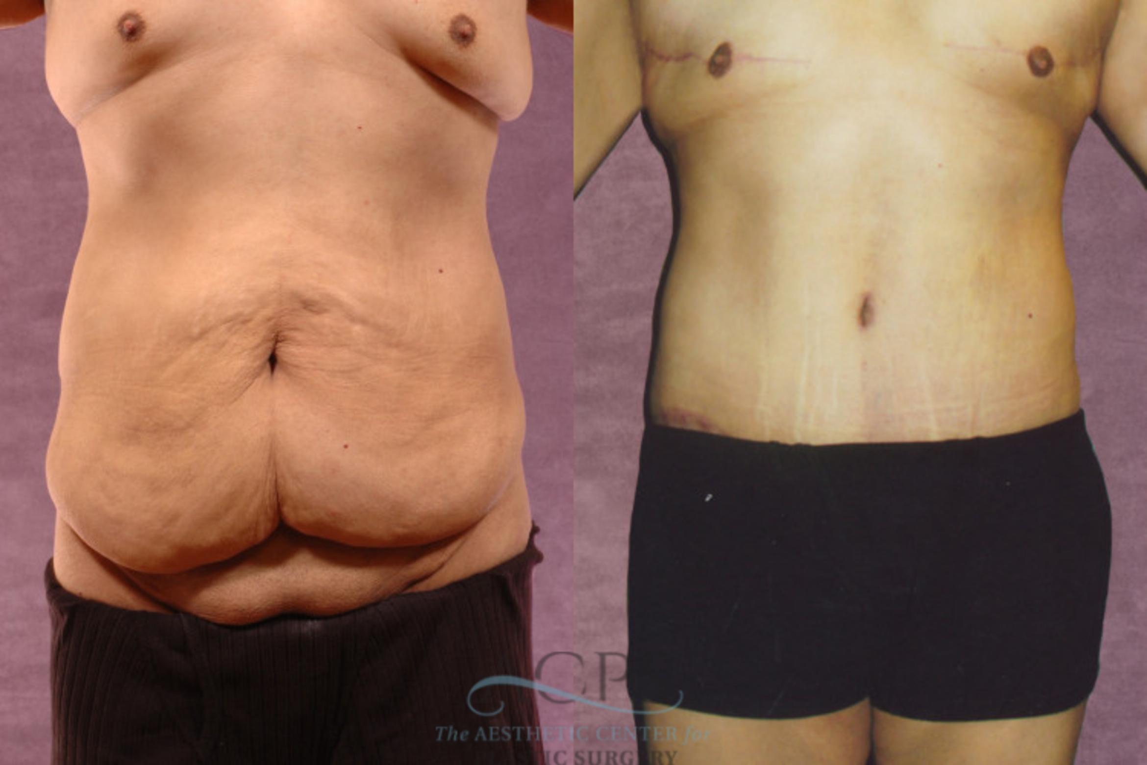 Before & After Tummy Tuck Case 44 Front View: View in Houston, TX