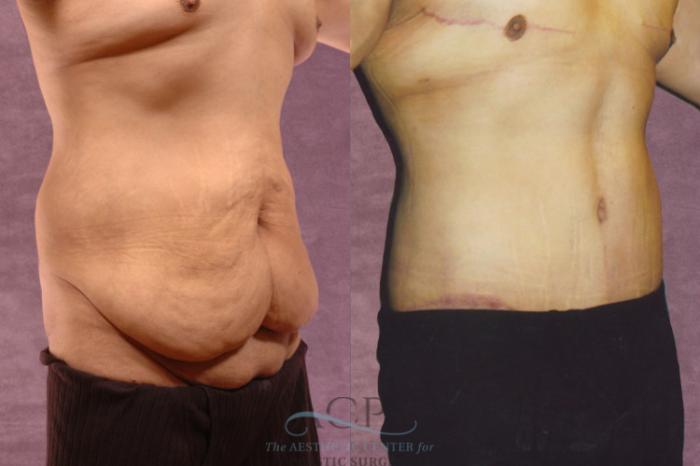 Before & After Tummy Tuck Case 44 Oblique Right View: View in Houston, TX