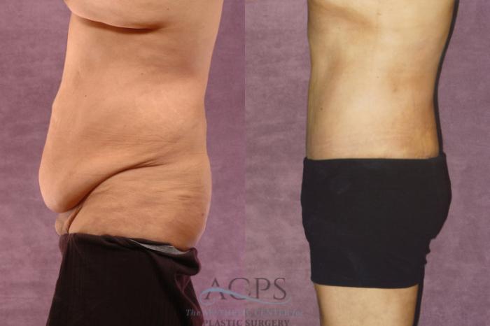Before & After Tummy Tuck Case 44 Side Left View: View in Houston, TX