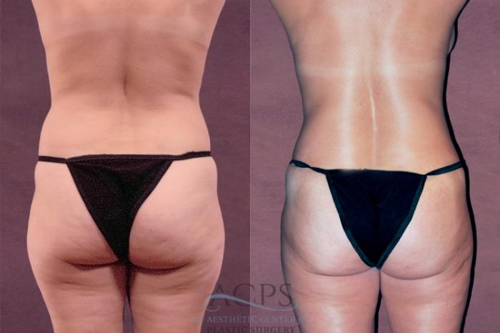 Before & After Tummy Tuck Case 45 Rear View: View in Houston, TX