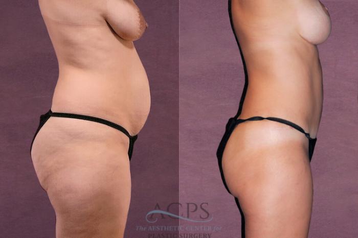 Before & After Tummy Tuck Case 45 Side View: View in Houston, TX