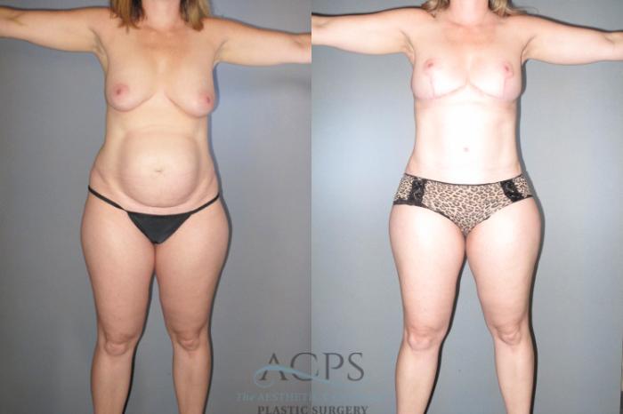 Before & After Tummy Tuck Case 46 Front View: View in Houston, TX