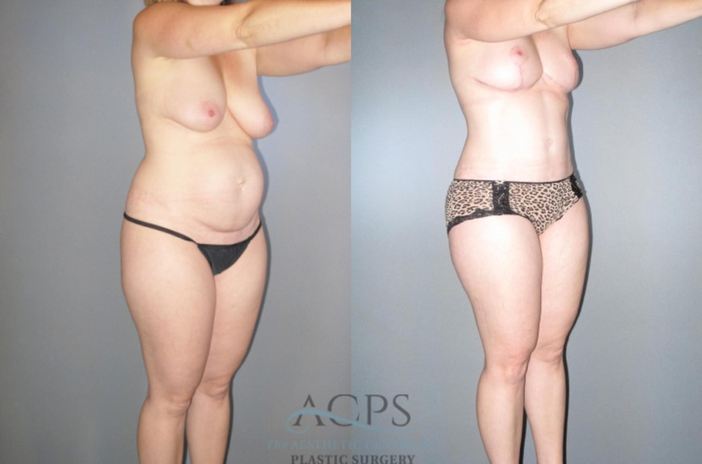Before & After Tummy Tuck Case 46 Oblique View: View in Houston, TX