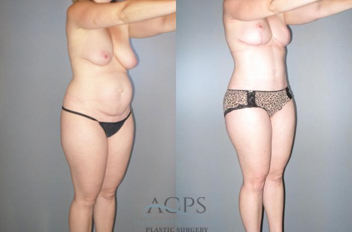 Before & After Tummy Tuck Case 46 Oblique View: View in Houston, TX