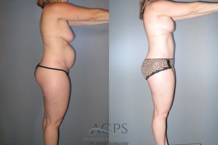 Before & After Tummy Tuck Case 46 Side View: View in Houston, TX