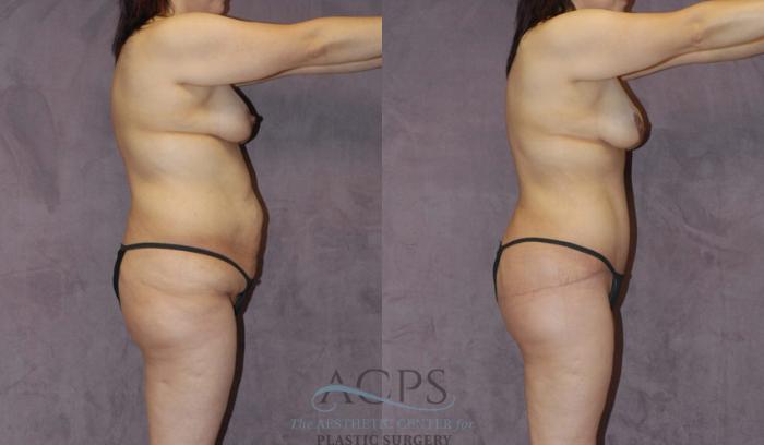 Before & After Body Lift Case 47 Side View: View in Houston, TX