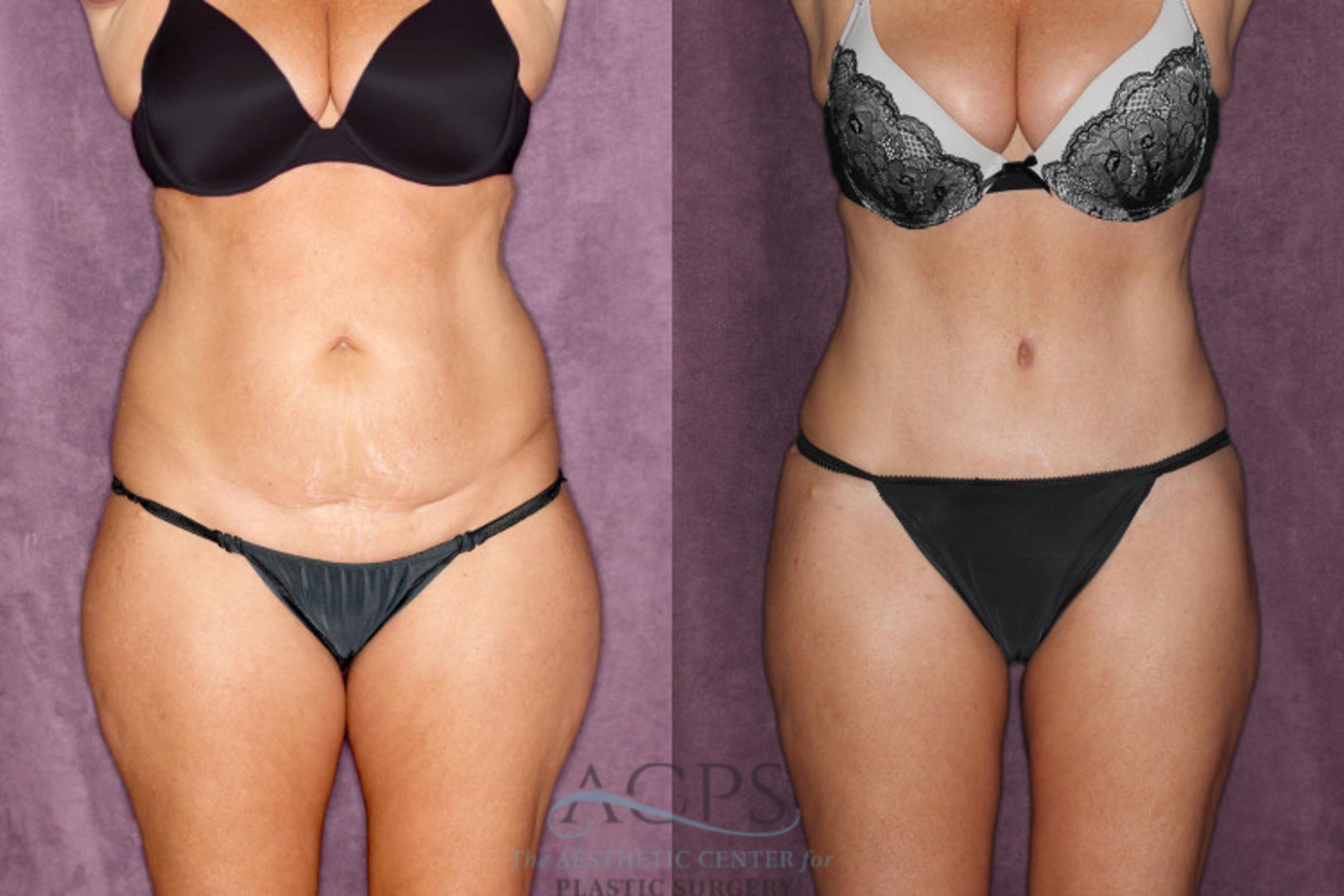 Before & After Tummy Tuck Case 48 Front View: View in Houston, TX
