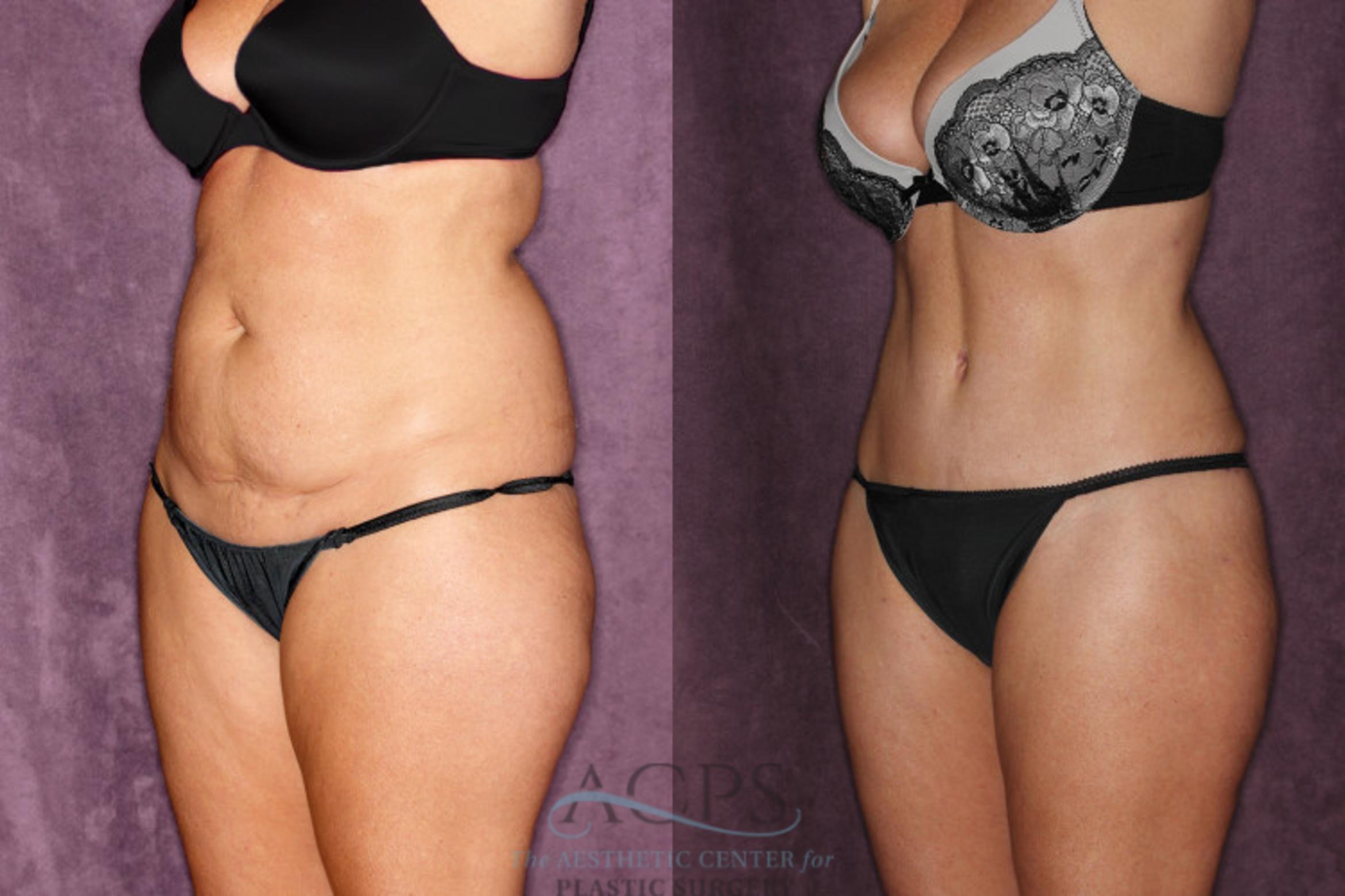 Before & After Tummy Tuck Case 48 Oblique Left View: View in Houston, TX