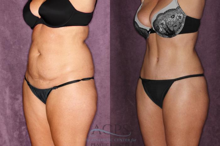 Before & After Tummy Tuck Case 48 Oblique Left View: View in Houston, TX